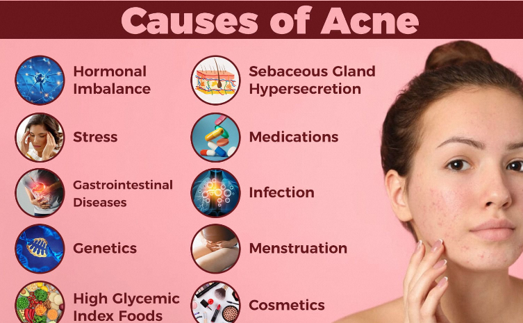WHAT CAUSE Acne