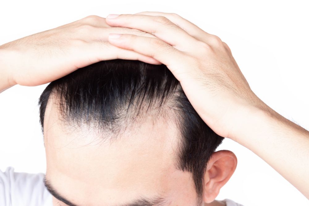 creatine cause hair loss