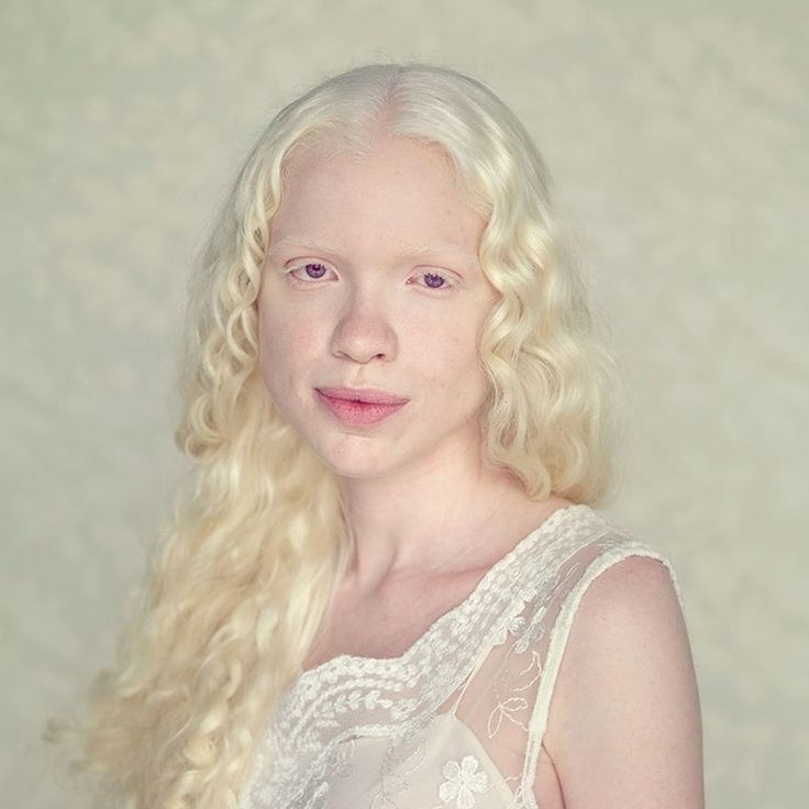 can albino people dye their hair