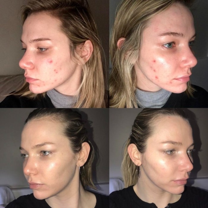 accutane hair loss treatment