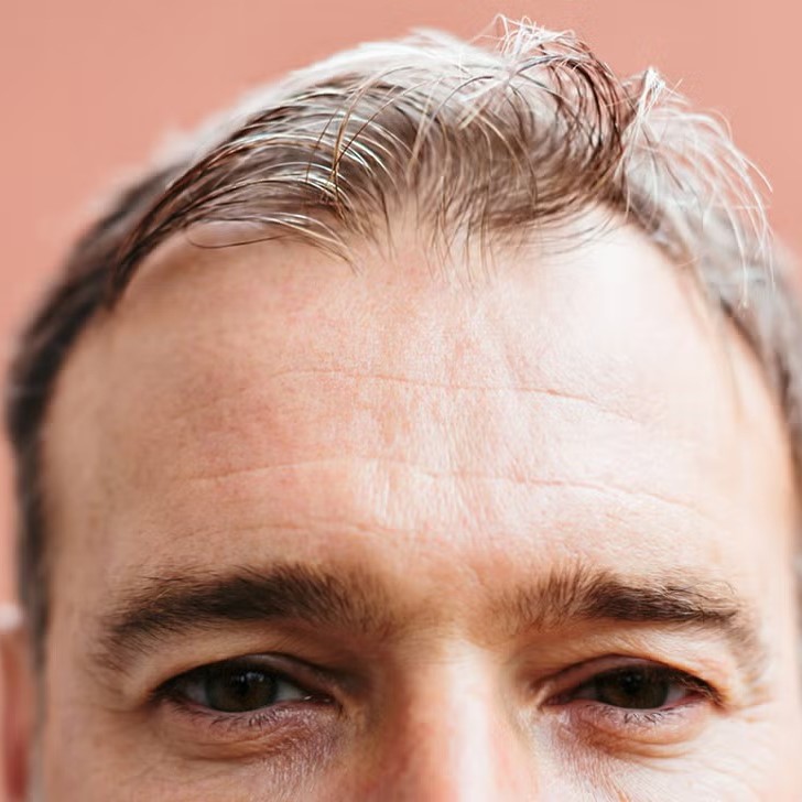 accutane hair loss treatment