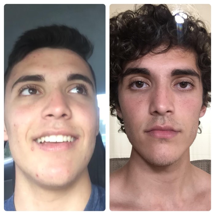 Accutane Hair Loss Treatment: Key Benefits You Should Know